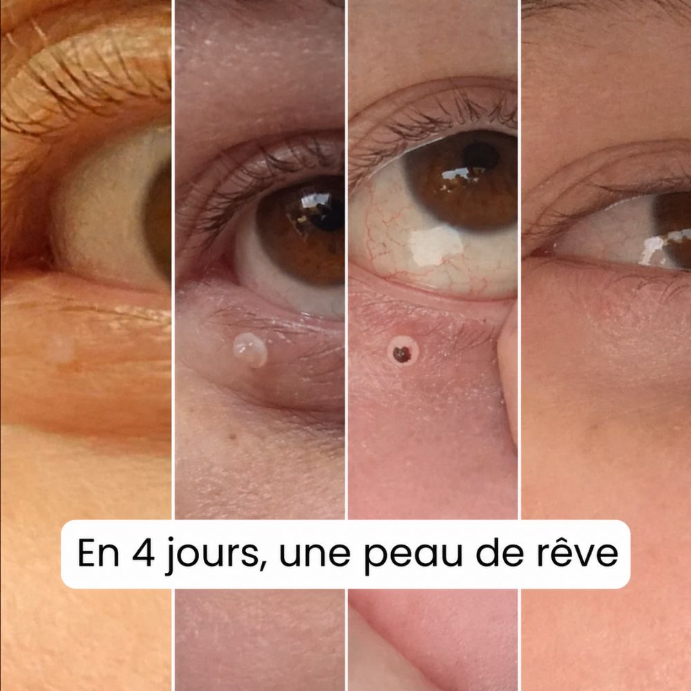 Proderma